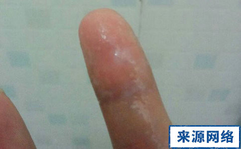 排卵期白带拉丝图片(4)(点击浏览下一张趣图)