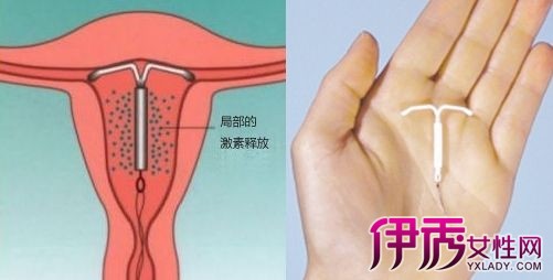 上环的好处和坏处 女人上环的好处和坏处(点击浏览下一张趣图)