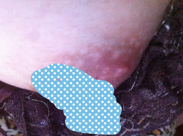 乳晕上面有疙瘩的图片(点击浏览下一张趣图)