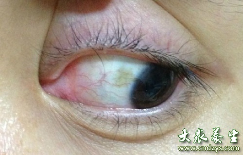 白眼球有黄斑(点击浏览下一张趣图)