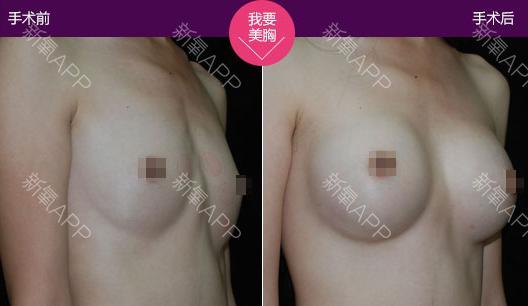 胸型有几种图解好看的图片:胸型有几种真人图片(7)(点击浏览下一张趣图)