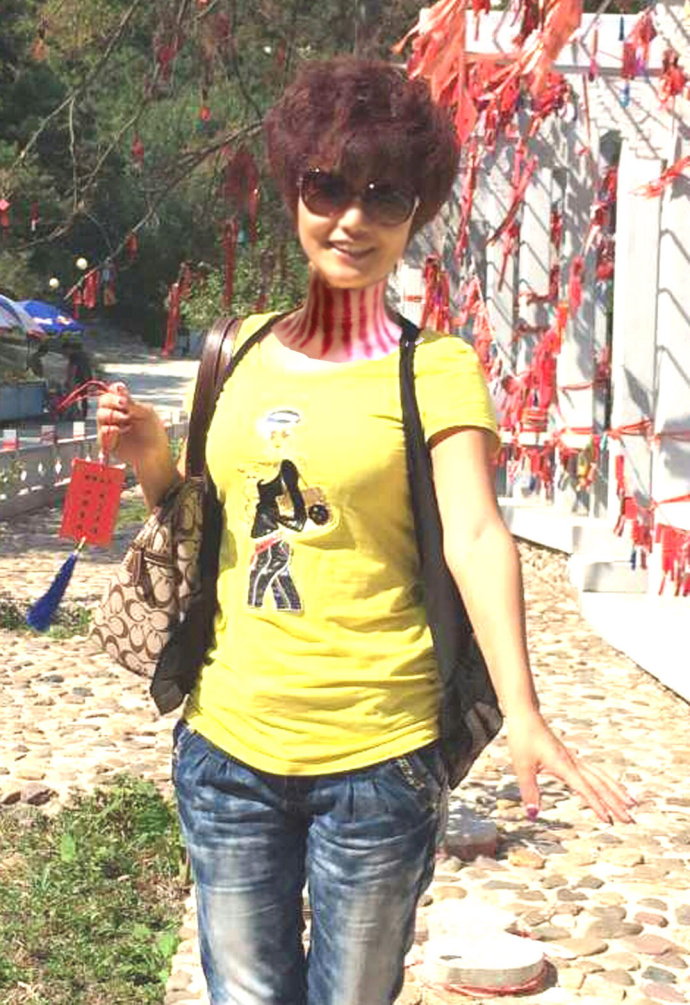 晚上给老婆揪痧视频tup揪得最好看的揪痧图片(2)(点击浏览下一张趣图)