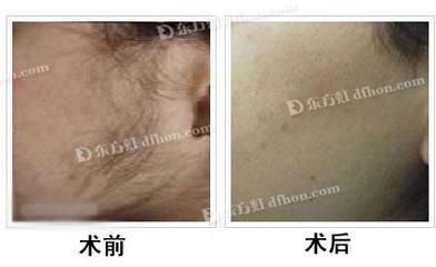 脱毛做完的图片 脱毛图片对比照片(4)(点击浏览下一张趣图)