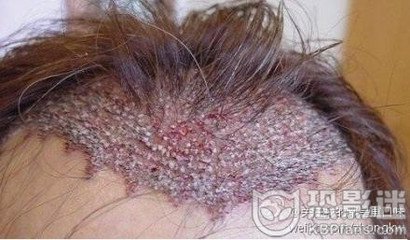 莲蓬乳取虫子视频图：密集恐惧症图片芝麻女(3)(点击浏览下一张趣图)