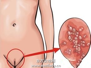 女性尖锐湿症状图(点击浏览下一张趣图)