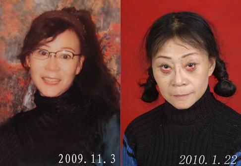 眼袋手术后失败图片(点击浏览下一张趣图)