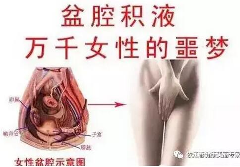 盆腔积液严重吗是什么意思?怎么引起的(点击浏览下一张趣图)