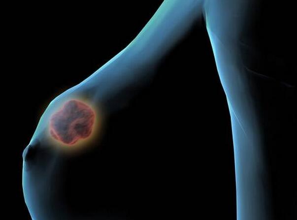 乳腺纤维腺瘤必须切吗？你真的了解吗(点击浏览下一张趣图)