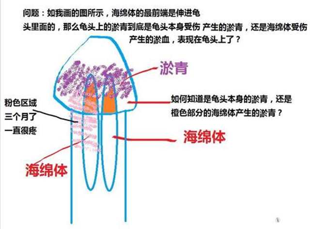恢复海绵体最好的办法(2)(点击浏览下一张趣图)