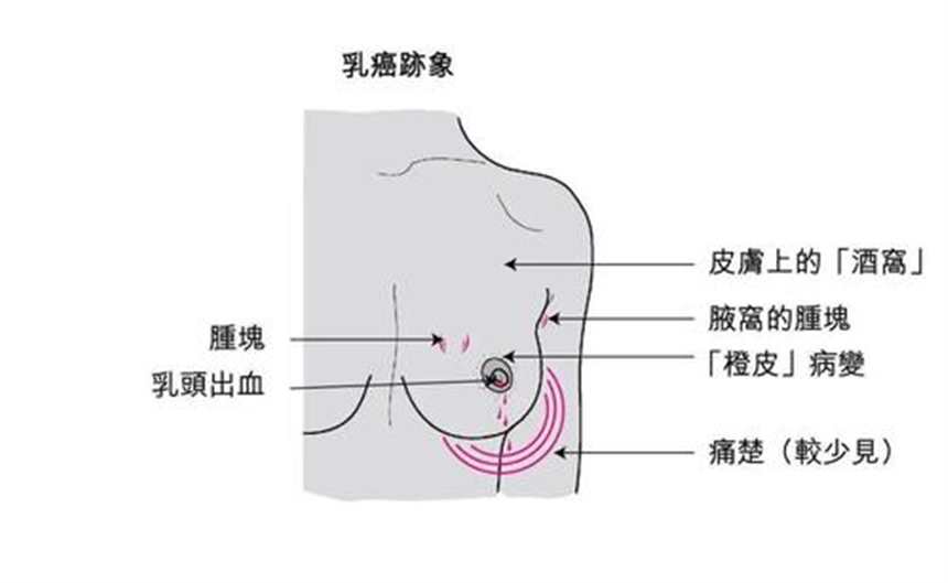 “防癌于未然”乳腺癌的15个征兆(3)(点击浏览下一张趣图)