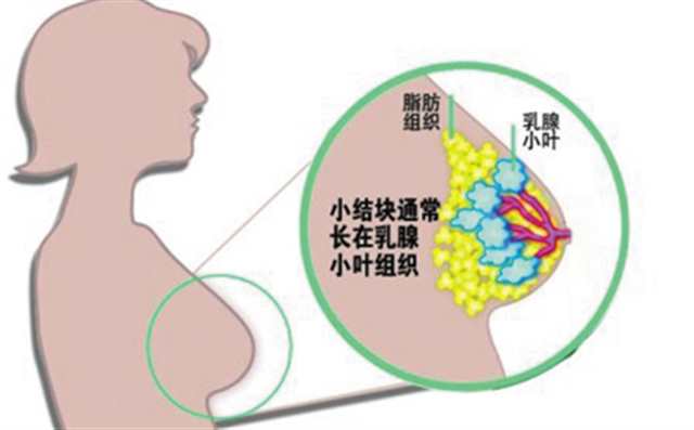乳腺癌的十大早期信号 一定要重视起来！(2)(点击浏览下一张趣图)