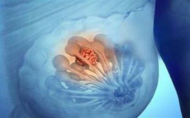 为什么说乳腺癌是幸福癌?这里有两个前提(3)(点击浏览下一张趣图)