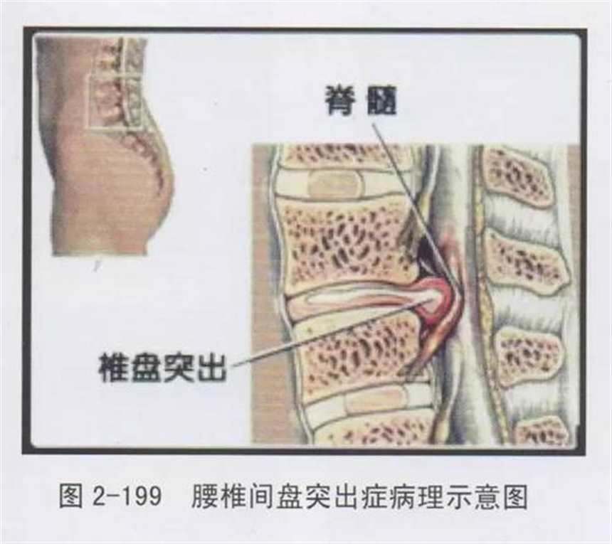 腰椎间盘突出腿疼厉害怎么办(3)(点击浏览下一张趣图)