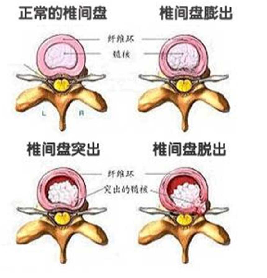 腰椎间盘突出腿疼厉害怎么办(4)(点击浏览下一张趣图)