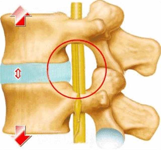 腰椎4—5突出屁股疼，麻木(点击浏览下一张趣图)