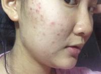 右脸颊长痘的原因