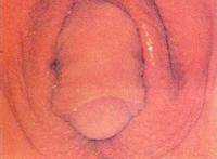 真正的阴阳人图片男女生殖器同时拥有