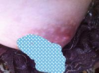 乳晕上面有疙瘩的图片