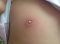 乳头有白色的物质