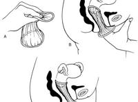 女性避孕套使用方法图解