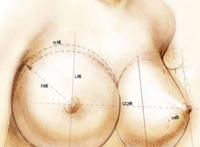 乳腺增生吃什么好?