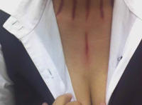 2977882910的揪痧图片 晚上给老婆揪痧视频