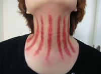 揪得最好看的揪痧图片 揪满全身痧的揪痧图片