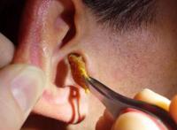 男子耳朵掏出巨型耳屎图片