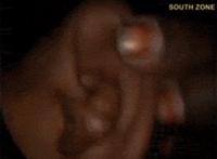 孩子10年不挖耳屎图片