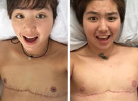 女变男手术过程图解：泰国变性手术全过程