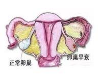 卵巢早衰的症状有哪些,卵巢早衰的症状吃什么