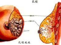 乳腺癌的十大早期信号 一定要重视起来！