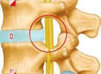 腰椎4—5突出屁股疼，麻木
