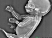 妈妈怀上人鱼宝宝 什么是美人鱼综合症？