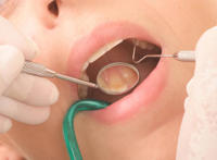 洗牙能去掉牙结石吗?