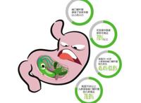 45岁女子感染幽门螺杆菌致胃癌