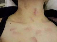 狼吻如何快速消除 方法很多都不如最后一招