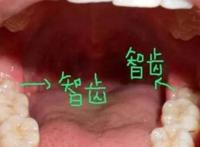 智齿一定要拔吗 不需要拔的智齿图片
