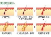 丁丁上长了痘痘，红肿发炎怎么办？