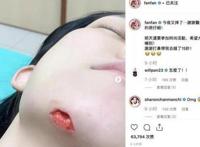 范玮琪下巴缝15针回应摔伤 范玮琪情商张韶涵事件引网友热议