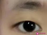 几种常见单眼皮的类型