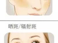 黄褐斑怎么去除最有效的方法有哪些