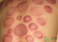 拔火罐可以减肥吗?拔火罐能减肥吗?