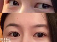 内双怎么进化成双眼皮？全是双眼皮贴的功劳