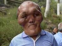 男子怪病似外星人，脸部持续肿大产生异形