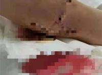 四川泸州一女生被体罚致残，学校一次性补偿39万元