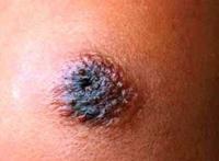 辽宁现炭疽病疫情 已确诊7例