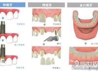 千万不要种植牙的5种情况，有这些情况的人种牙失败率会很高