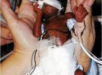 世界上最小的婴儿，阿米利娅·泰勒(仅重280克/长24厘米)