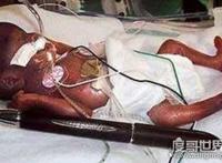 世界上最小的婴儿，阿米莉亚出生仅25cm重280克